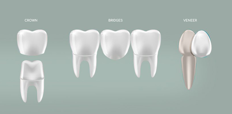 Dentures, Bridges, Veneers & Crowns